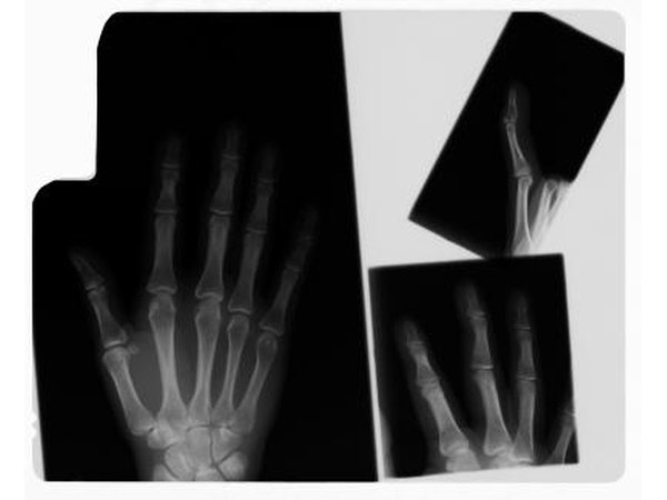 Hand x-rays
