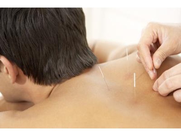 A man receives acupuncture.