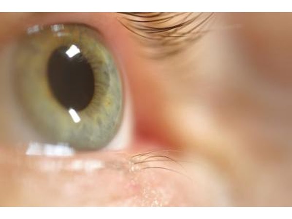 Problems with the lower eyelid may also cause the eyes to water.