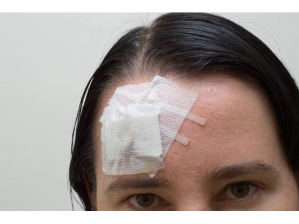 Head injury may cause double vision.