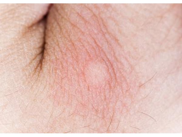 Mosquito bite.