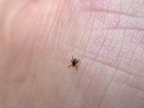 Tick on human skin.