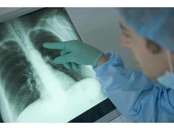 Doctor pointing to lungs with sign of cancer