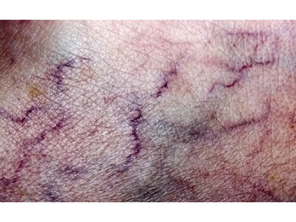 Varicose veins cause blood to pool.
