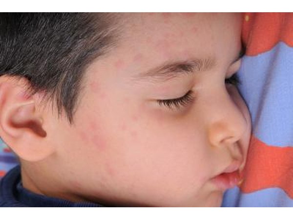 Rubella.