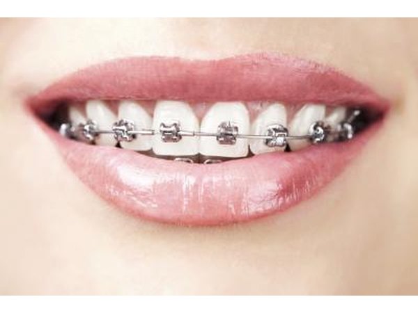 Metal braces.