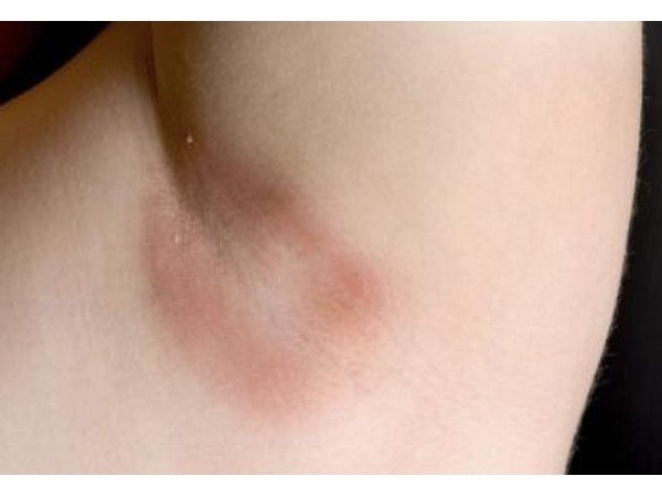 Yeast Infection