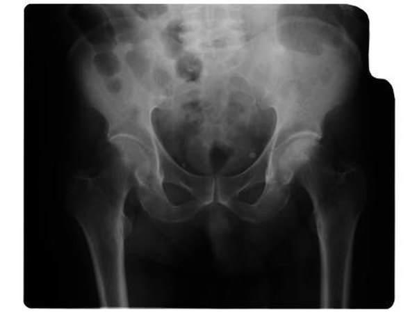 xray of tailbone