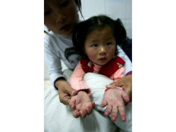 Two year old girl with hand, foot, and mouth disease