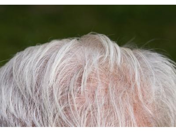 People with ringworm may never grow hair in the areas of the scalp that have been affected