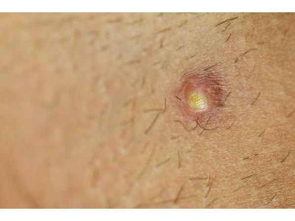 In all stages of the condition, folliculitis, furncles and carbuncles may form a puss that drains.