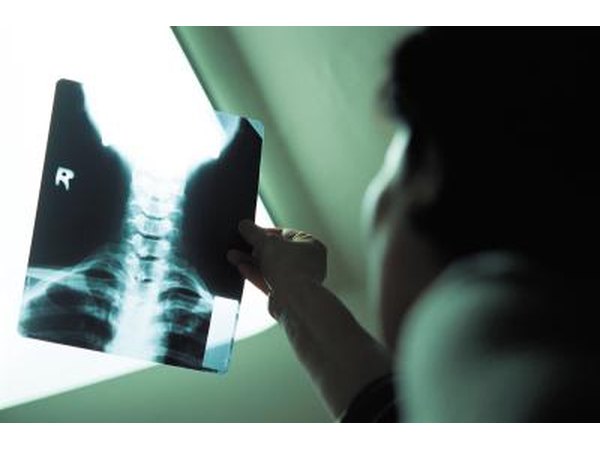 Spinal conditions causing hand, arm and shoulder pain usually affect your cervical spine.