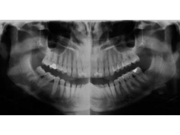 Panoramic X-ray of human teeth and jaw