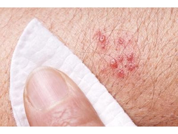 Shingles is caused by the varicella-zoster virus, the same one that causes chickenpox