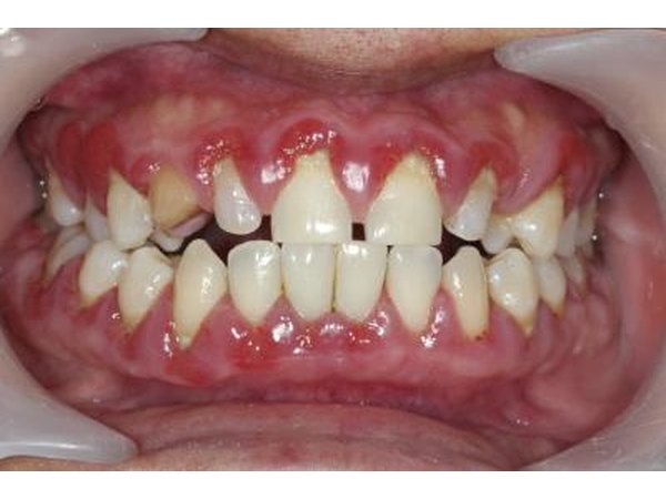 Gum disease.