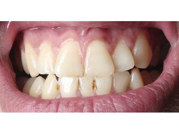 Gum disease.