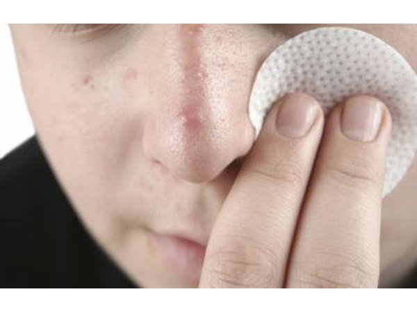 This supplement can be used to treat acne.