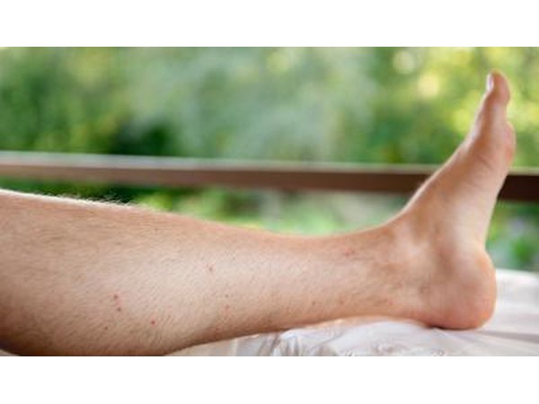 Swelling in the foot may be a sign of DVT.