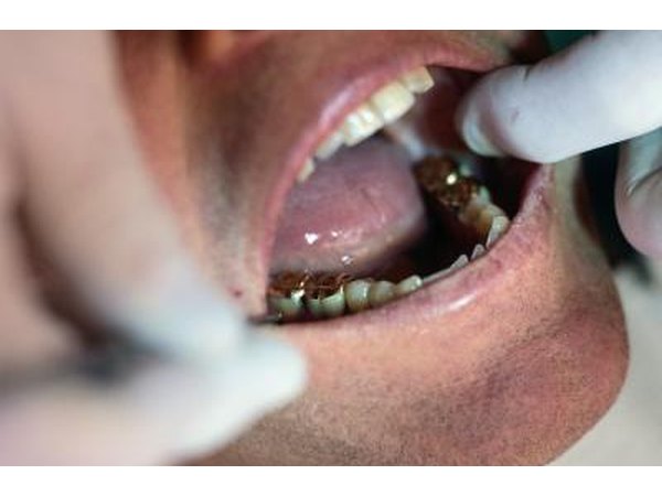 A crown on patient's tooth.