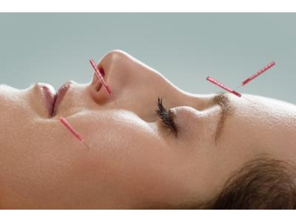 Acupuncture is gaining popularity in relieving back pain.