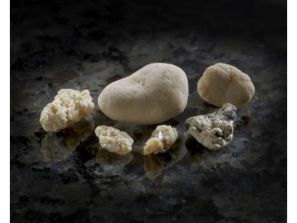 Kidney stones that have been passed.