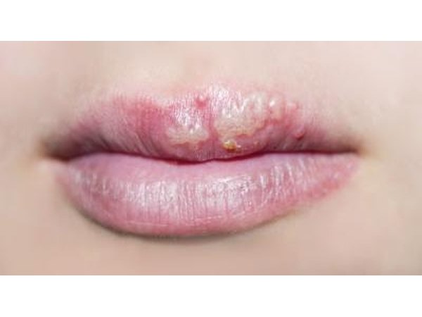 Cold sores.