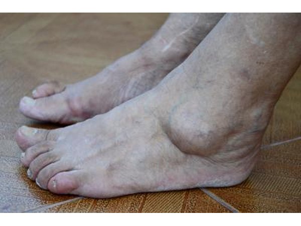 Close up of severely swollen feet