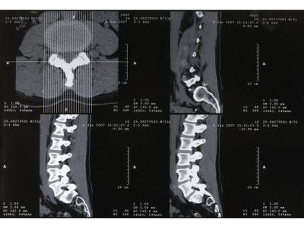 Scans of lumbosacral spine.