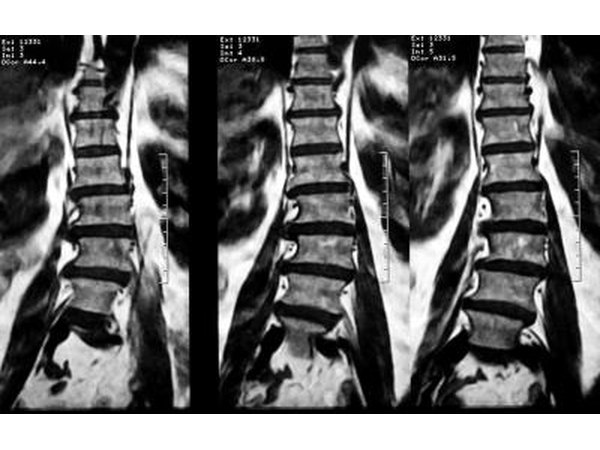 MRI of lumbar spinal scoliosis.