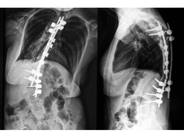 X-rays of a spine with scoliosis.