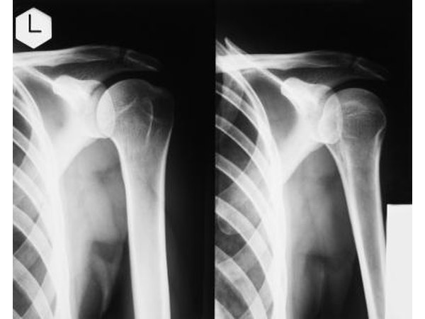 The supraspinatus is one of the major muscles of the rotator cuff.