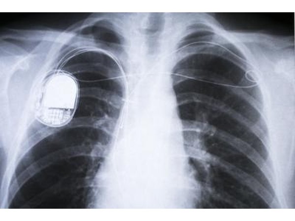 X-ray of human chest with pacemaker installed.
