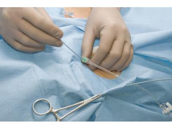 A catheter.