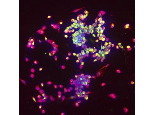 activated lymphocytes attacking foreign bodies