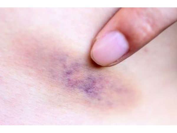 Bruise on leg.