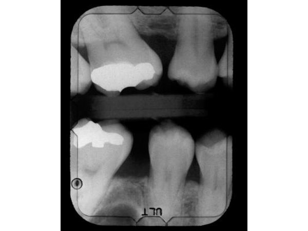 Dental x-ray showing cavities and fillings