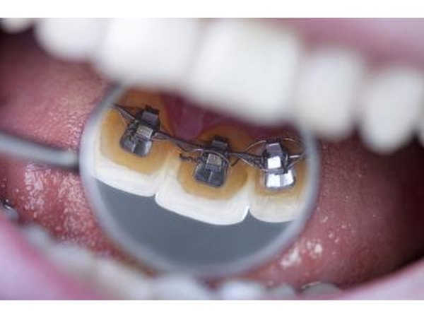 Lingual braces.
