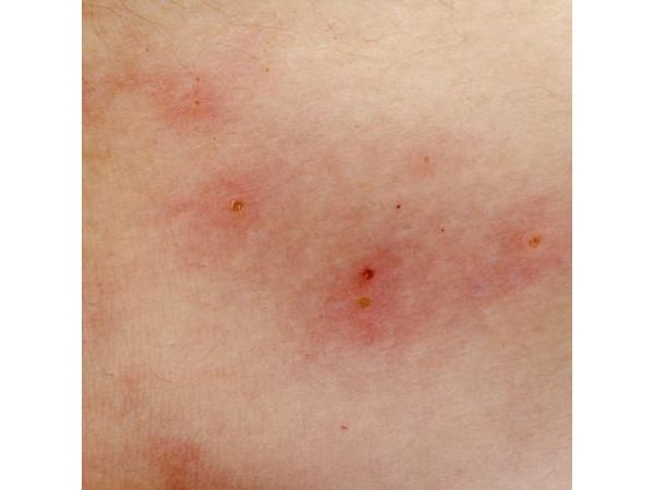 Chlorine is a skin irritant which can cause a rash if a swimmer is repeatedly exposed to chlorinated water