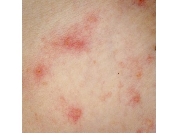Allergic rash on skin.