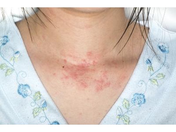 Rash on a female neck.