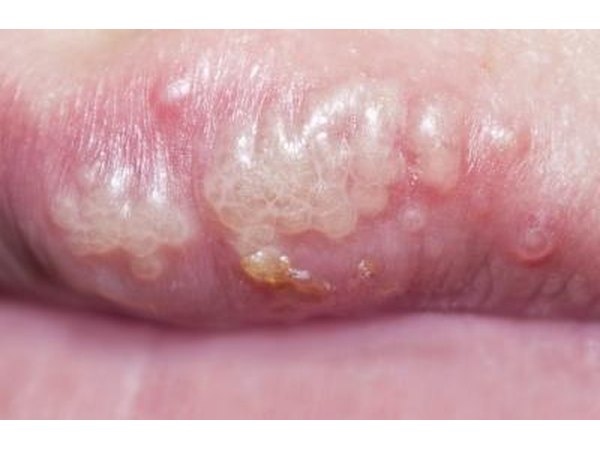 Close up of herpes on lips.