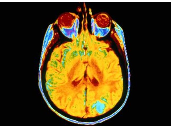 Brain scan showing presence of cancer