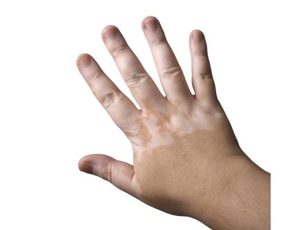 People with autoimmune conditions are at higher risk.