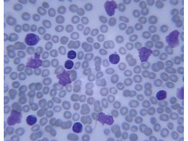 Leukemia is a form of cancer. White blood cells are overproduced in the bone marrow and ultimately begin to overtake red blood cells.
