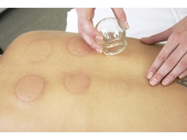 Cupping.