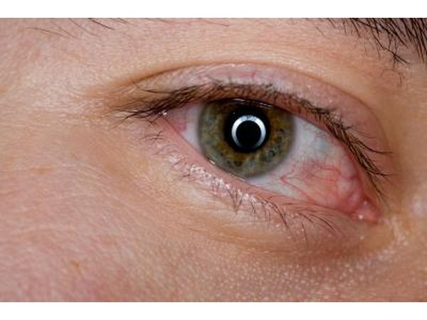 Eye irritation is a symptom of ink poisoning.