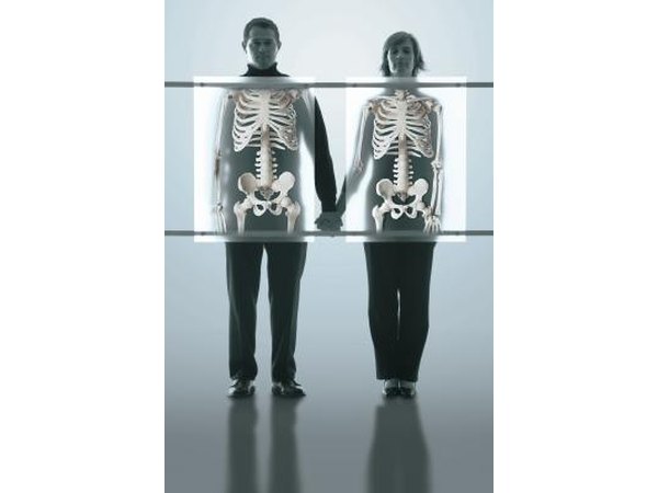 Osteoporosis is a condition in which the bones become brittle and prone to fracture