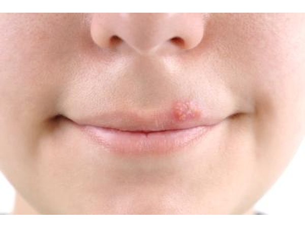 Herpes on the mouth.