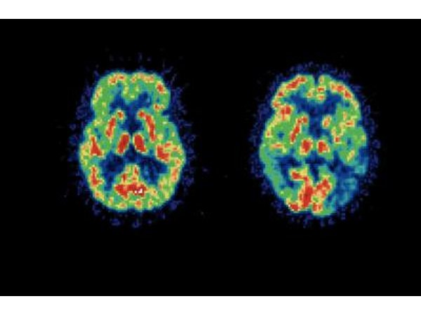 PET brain scan result comparison