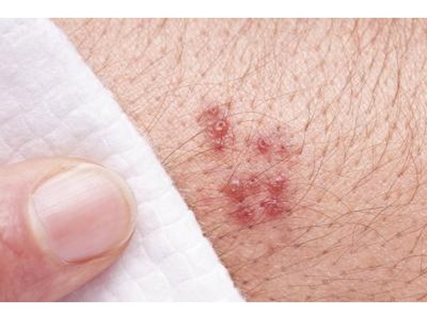 A shingles rash.